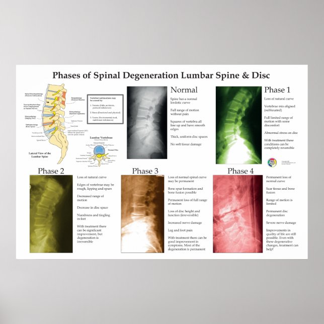 Poster Spinal Degeneration Lumbar Spine Chiropractic (Devant)