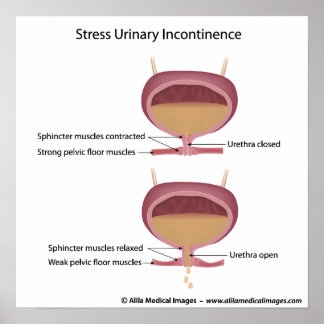 Poster Stress incontinence urinaire chez les femmes.