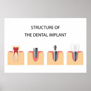 Poster Structure de l'implant dentaire