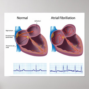 Poster sur la fibrillation auriculaire des maladie