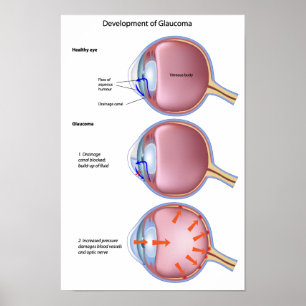 Poster sur la maladie des yeux Glaucome