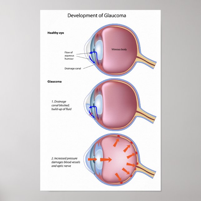 Poster sur la maladie des yeux Glaucome (Devant)