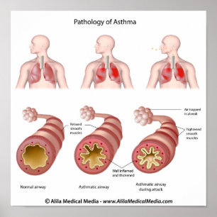 Poster sur la maladie pulmonaire Asthma