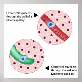 Poster sur la métastase des cellules cancéreuses