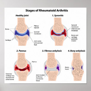 Poster sur la polyarthrite rhumatoïde