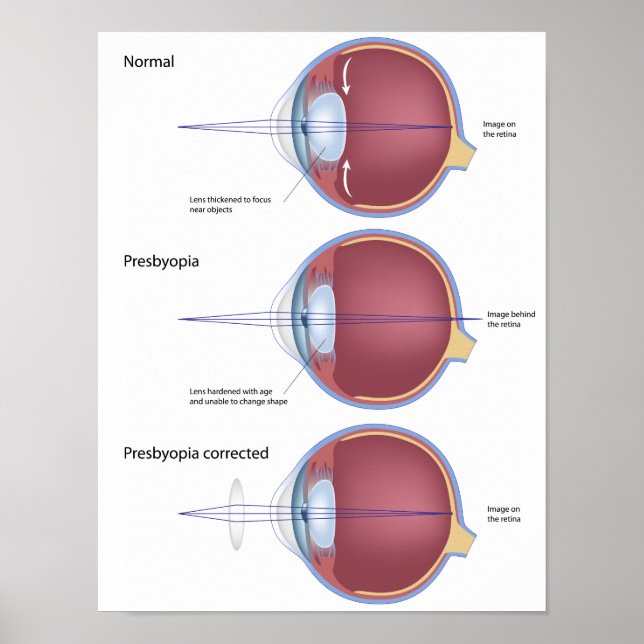 Poster sur la presbyopie des yeux (Devant)
