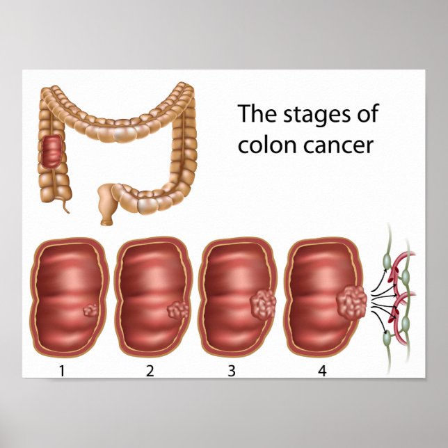Poster sur la progression du cancer du côlon (Devant)