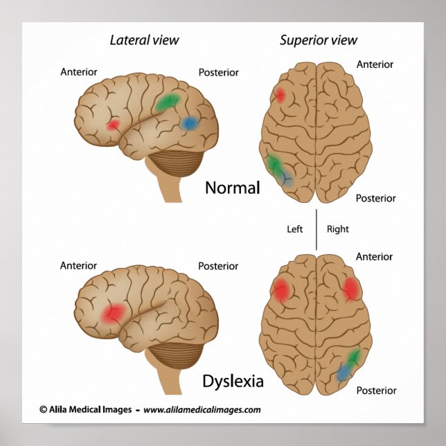 Poster sur l'activité cérébrale de la dyslexie (Devant)