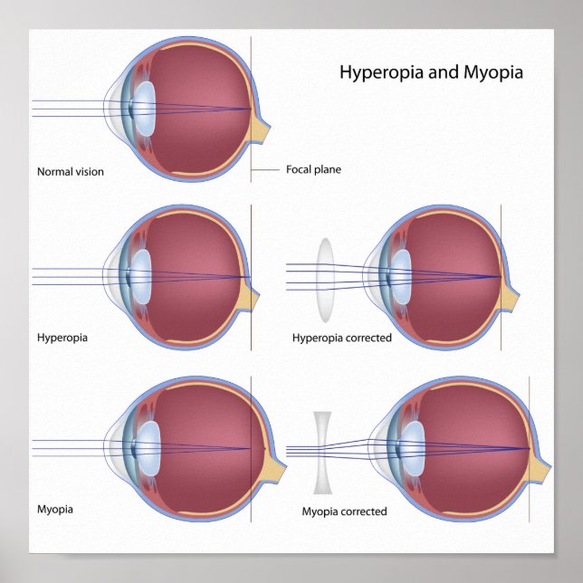 Poster sur les défauts oculaires courants (Devant)