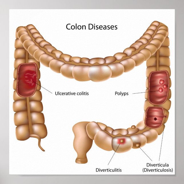 Poster sur les pathologies du côon (Devant)