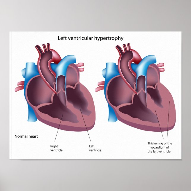 Poster sur l'hypertrophie cardiaque (Devant)