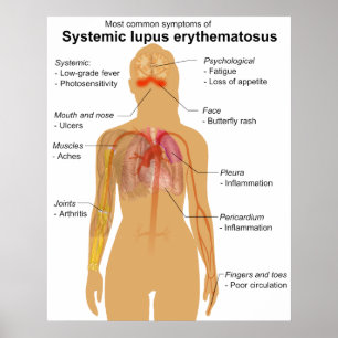 Poster Symptom Graphique du lupus érythémateux systémique