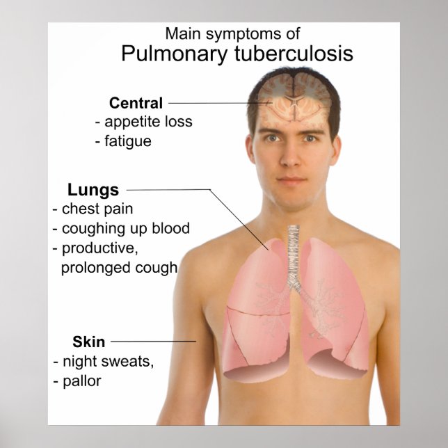 Poster Symptômes principaux de la tuberculose pulmonaire (Devant)