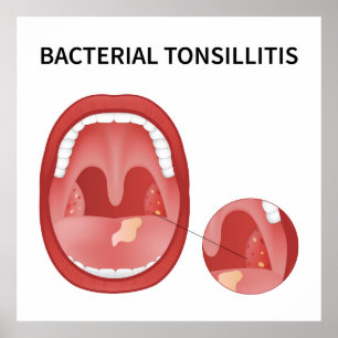 Poster Ttonsillite bactérienne
