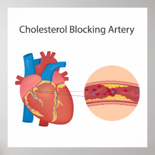 Poster Vaisseaux sanguins étroits
