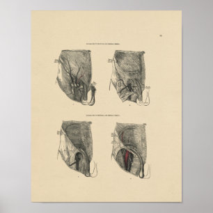 Poster Vintage Hernia Anatomy 1880 Imprimer