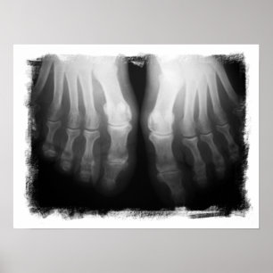Poster X-Ray Pieds humains Skeleton Bones noir et blanc