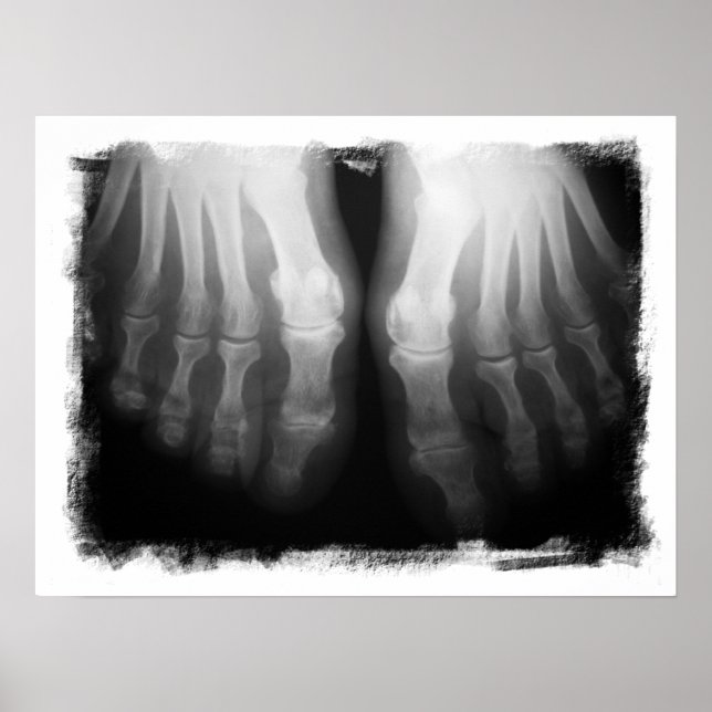 Poster X-Ray Pieds humains Skeleton Bones noir et blanc (Devant)