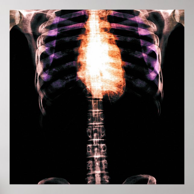 POSTER X-RAY SKELETON TORSO RIBS - ORIGINAL (Devant)
