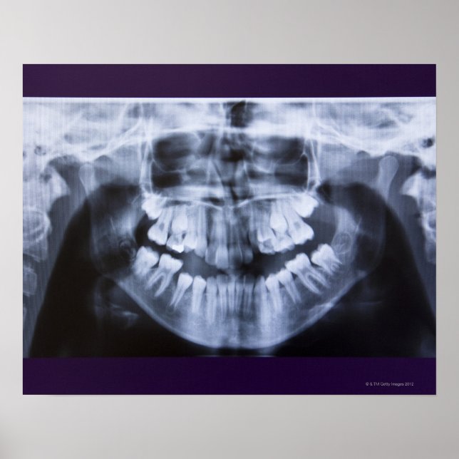 Poster Xray d'une mâchoire fillette prise avec le panoram (Devant)