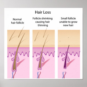 Processus de perte de cheveux Poster
