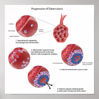 Progression of pulmonary tuberculosis Poster