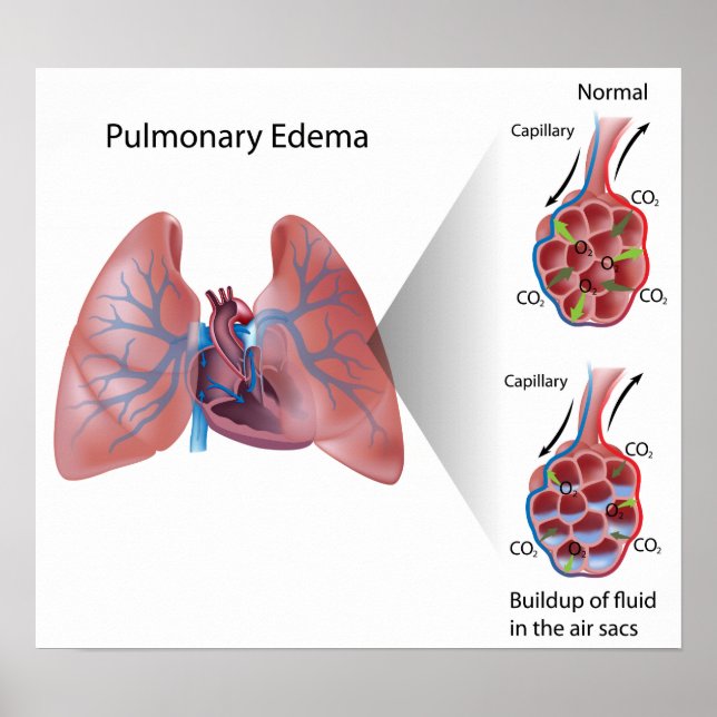 Pulmonary edema Poster (Front)