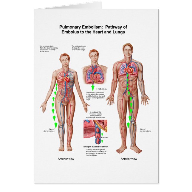 Pulmonary Embolism, Pathway Of Embolus (Front)