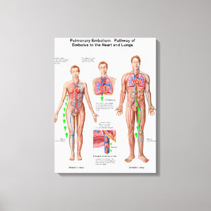 Pulmonary Embolism, Pathway Of Embolus Canvas Print