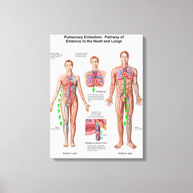 Pulmonary Embolism, Pathway Of Embolus Canvas Print (Front)