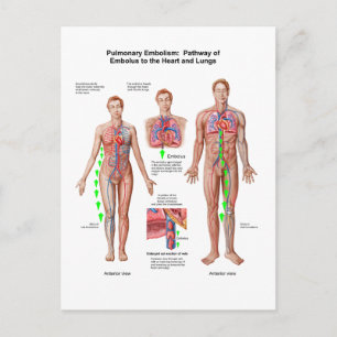 Pulmonary Embolism, Pathway Of Embolus Postcard