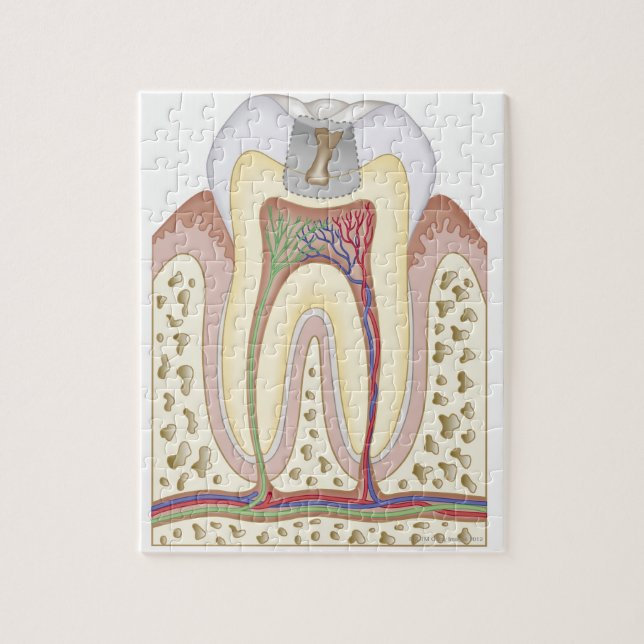 Puzzle Illustration de la carie dentaire (Vertical)