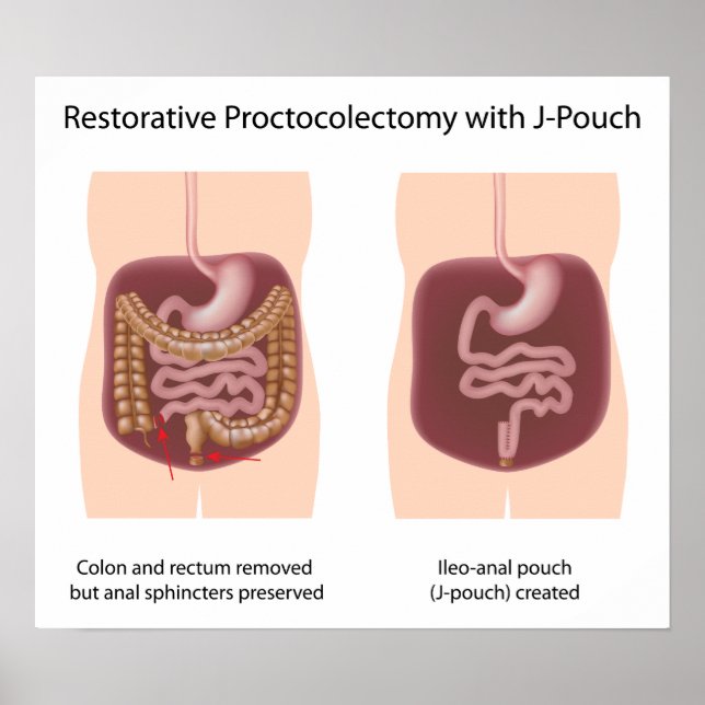 Restorative proctocolectomy surgery with j-pouch poster (Front)