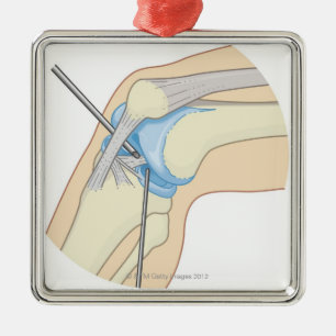 Rigid Endoscopy Procedure Metal Ornament