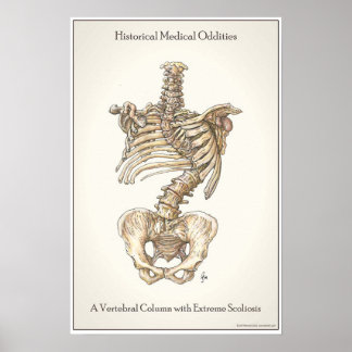 Scoliosis Spine Poster
