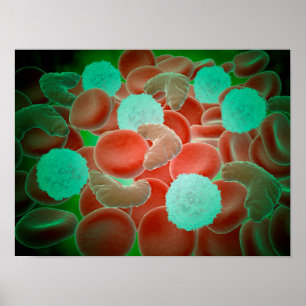 Sickle Cell Anemia With Red Blood Cells Poster