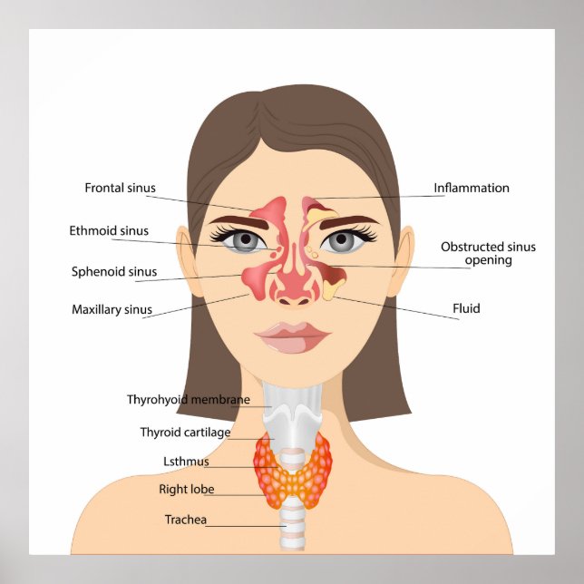 Sinusitis Poster (Front)
