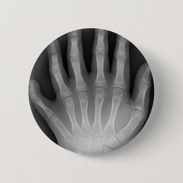 Six Fingered Hand, Medical Rarity, X-Ray 2 Inch Round Button (Front)