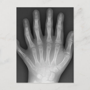Six Fingered Hand, Medical Rarity, X-Ray Postcard