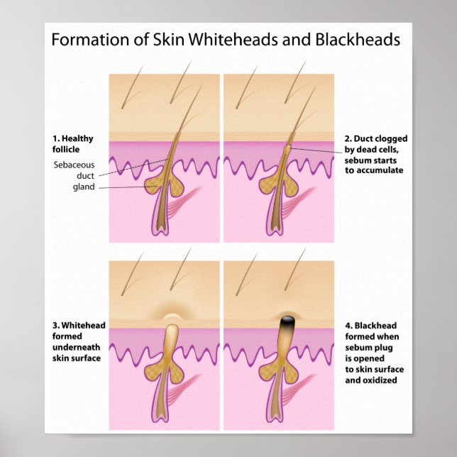 Skin blackhead Poster (Front)