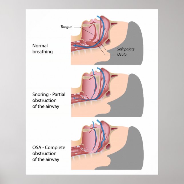 Snoring and sleep apnea Poster (Front)