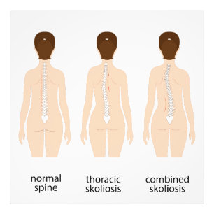 Spinal deformity photo print