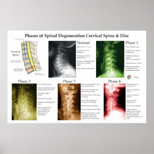 Spinal Degeneration Cervical Spine Chiropractic Poster