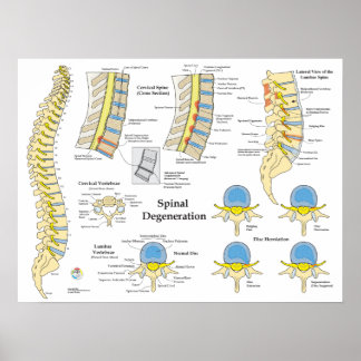 Spinal Degeneration Disc Herniation Poster