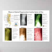 Spinal Degeneration Lumbar Spine Chiropractic