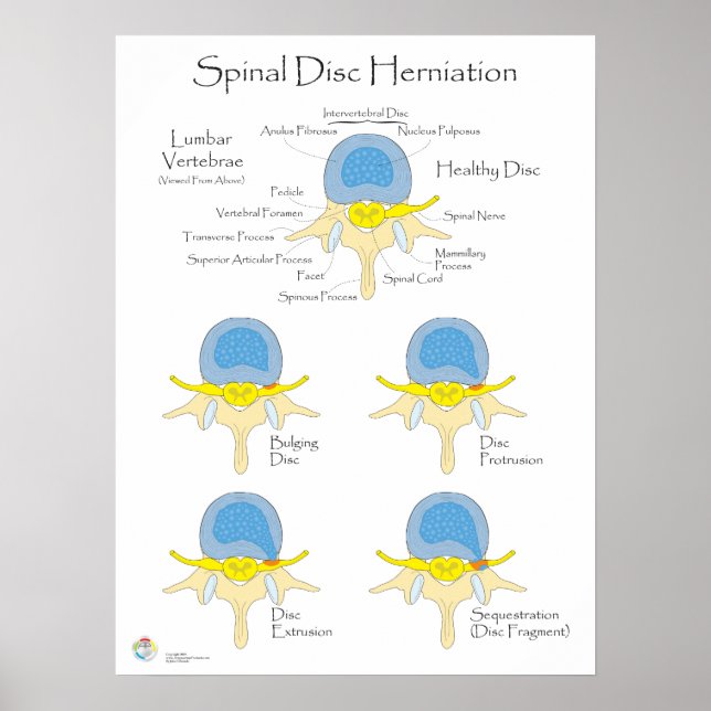 Spinal Disc Herniation Poster Medical Poster (Front)