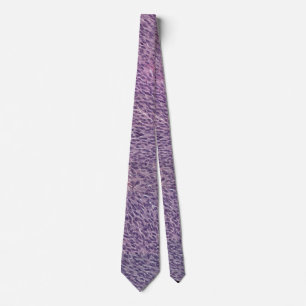Spindle melanoma necktie