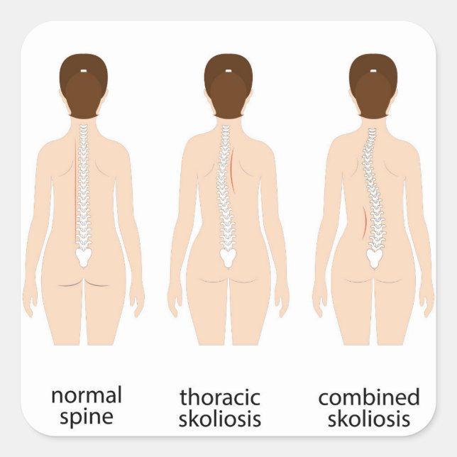 Sticker Carré Déformité de la colonne vertébrale (Devant)