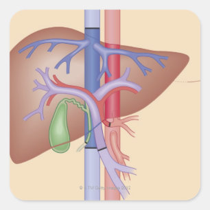 Sticker Carré Procédure de greffe de foie