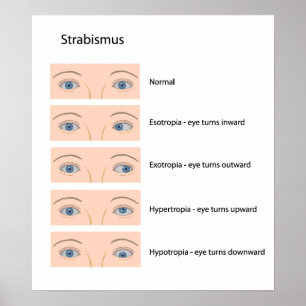 Strabismus eye defect Poster